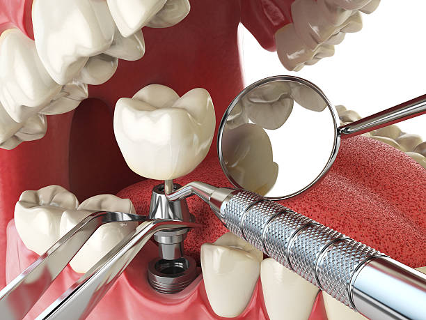 Best Emergency Tooth Extraction in Drumright, OK